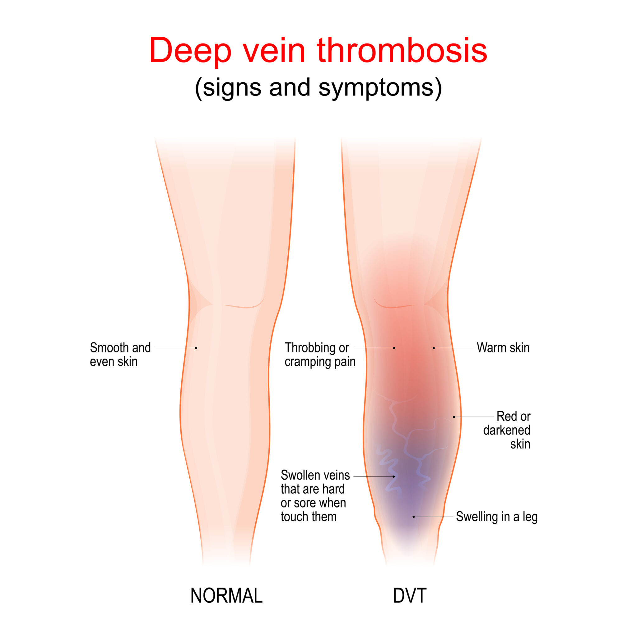 What You Need to Know About Deep Vein Thrombosis (DVT) - Susan Biegel MD